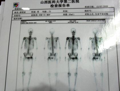 许先生服用人参皂苷rh2生活自理